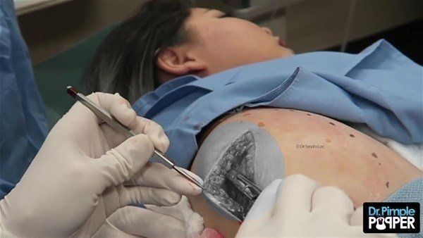 Yer: Zonguldak! 50 yıldır yüzündeydi... Ameliyatla burnundan çıkarılanlar şoke etti 39