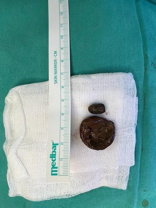 Yer: Zonguldak! 50 yıldır yüzündeydi... Ameliyatla burnundan çıkarılanlar şoke etti 4