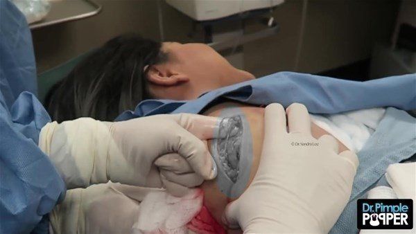 Yer: Zonguldak! 50 yıldır yüzündeydi... Ameliyatla burnundan çıkarılanlar şoke etti 42