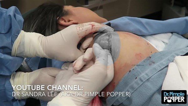 Yer: Zonguldak! 50 yıldır yüzündeydi... Ameliyatla burnundan çıkarılanlar şoke etti 43