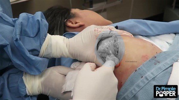 Yer: Zonguldak! 50 yıldır yüzündeydi... Ameliyatla burnundan çıkarılanlar şoke etti 44