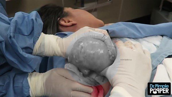 Yer: Zonguldak! 50 yıldır yüzündeydi... Ameliyatla burnundan çıkarılanlar şoke etti 46