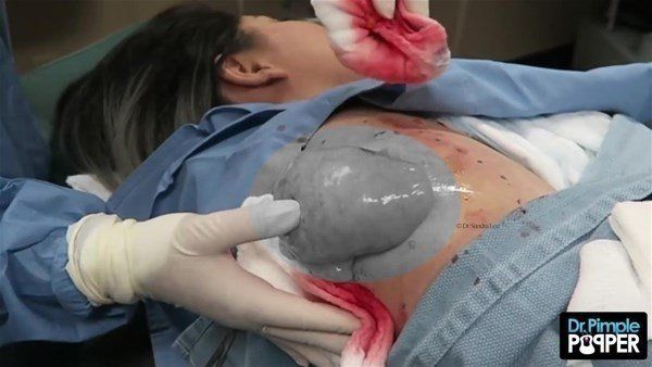 Yer: Zonguldak! 50 yıldır yüzündeydi... Ameliyatla burnundan çıkarılanlar şoke etti 47