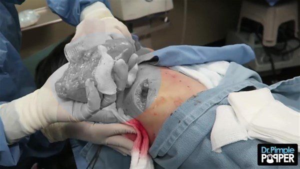 Yer: Zonguldak! 50 yıldır yüzündeydi... Ameliyatla burnundan çıkarılanlar şoke etti 49