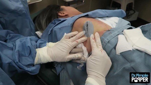 Yer: Zonguldak! 50 yıldır yüzündeydi... Ameliyatla burnundan çıkarılanlar şoke etti 50