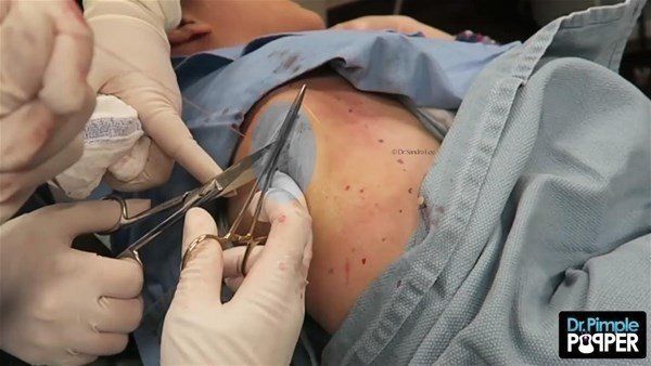 Yer: Zonguldak! 50 yıldır yüzündeydi... Ameliyatla burnundan çıkarılanlar şoke etti 53