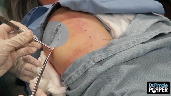 Yer: Zonguldak! 50 yıldır yüzündeydi... Ameliyatla burnundan çıkarılanlar şoke etti 55