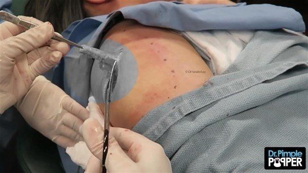 Yer: Zonguldak! 50 yıldır yüzündeydi... Ameliyatla burnundan çıkarılanlar şoke etti 56