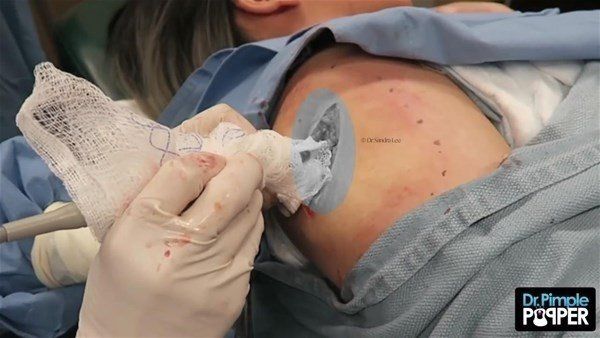 Yer: Zonguldak! 50 yıldır yüzündeydi... Ameliyatla burnundan çıkarılanlar şoke etti 57