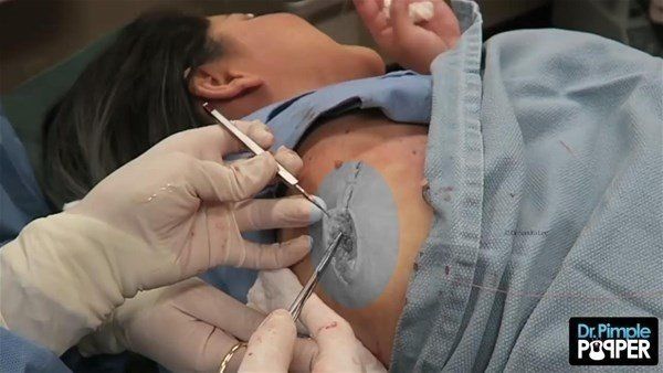 Yer: Zonguldak! 50 yıldır yüzündeydi... Ameliyatla burnundan çıkarılanlar şoke etti 58