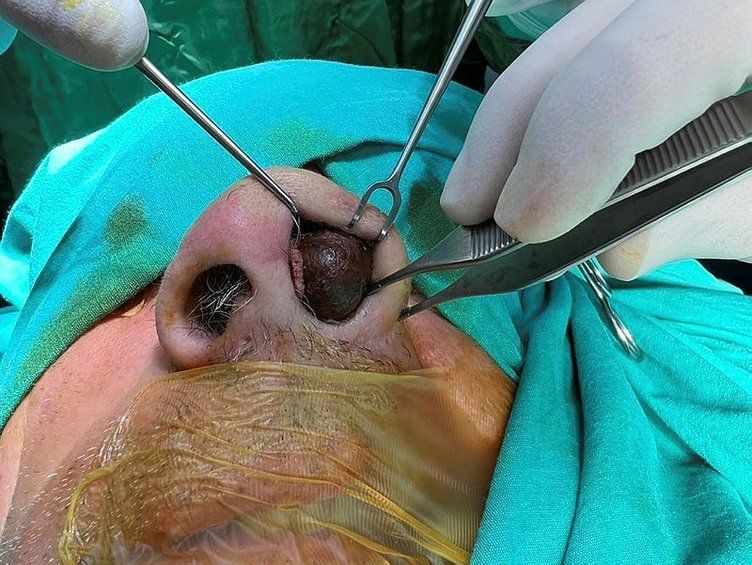 Yer: Zonguldak! 50 yıldır yüzündeydi... Ameliyatla burnundan çıkarılanlar şoke etti 6