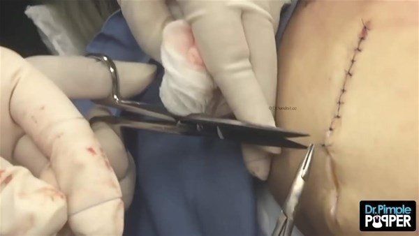 Yer: Zonguldak! 50 yıldır yüzündeydi... Ameliyatla burnundan çıkarılanlar şoke etti 62