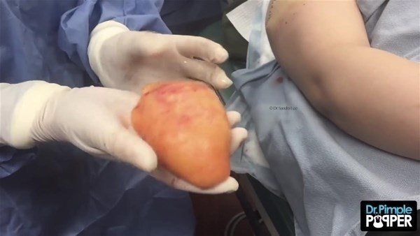 Yer: Zonguldak! 50 yıldır yüzündeydi... Ameliyatla burnundan çıkarılanlar şoke etti 64