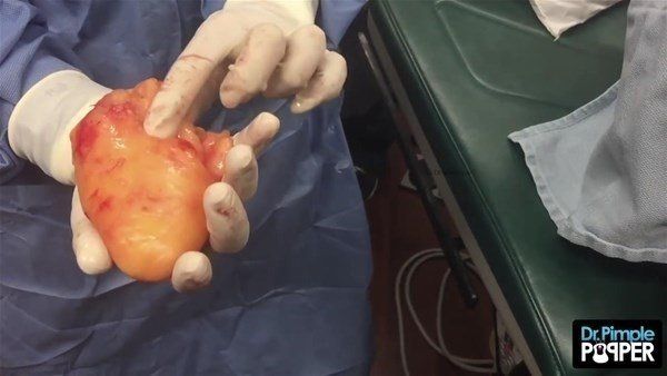 Yer: Zonguldak! 50 yıldır yüzündeydi... Ameliyatla burnundan çıkarılanlar şoke etti 65