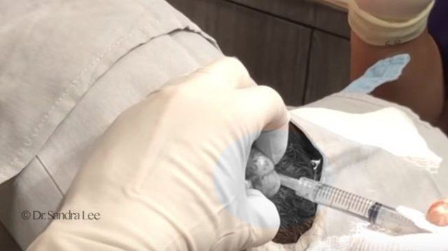 Yer: Zonguldak! 50 yıldır yüzündeydi... Ameliyatla burnundan çıkarılanlar şoke etti 69