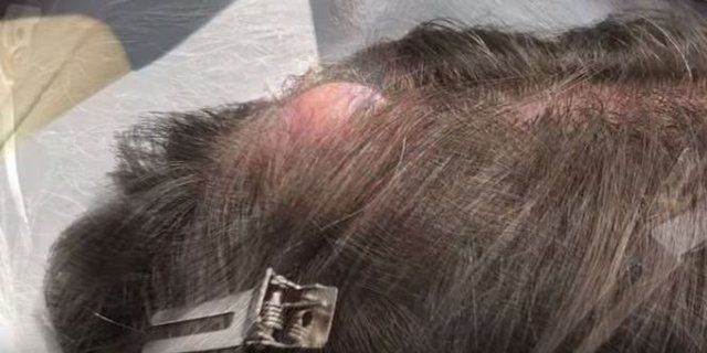 Yer: Zonguldak! 50 yıldır yüzündeydi... Ameliyatla burnundan çıkarılanlar şoke etti 70