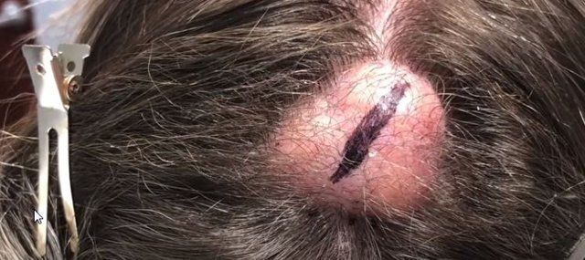 Yer: Zonguldak! 50 yıldır yüzündeydi... Ameliyatla burnundan çıkarılanlar şoke etti 71