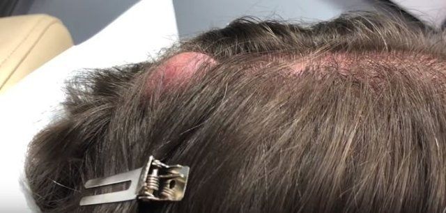 Yer: Zonguldak! 50 yıldır yüzündeydi... Ameliyatla burnundan çıkarılanlar şoke etti 72