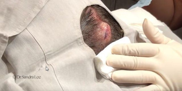 Yer: Zonguldak! 50 yıldır yüzündeydi... Ameliyatla burnundan çıkarılanlar şoke etti 73