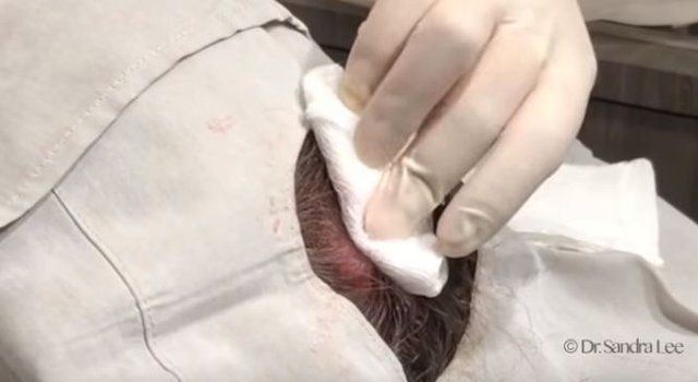 Yer: Zonguldak! 50 yıldır yüzündeydi... Ameliyatla burnundan çıkarılanlar şoke etti 75