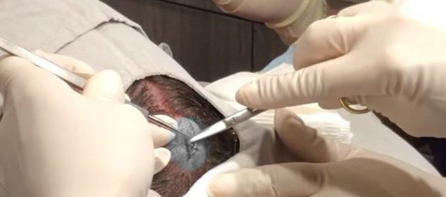 Yer: Zonguldak! 50 yıldır yüzündeydi... Ameliyatla burnundan çıkarılanlar şoke etti 76