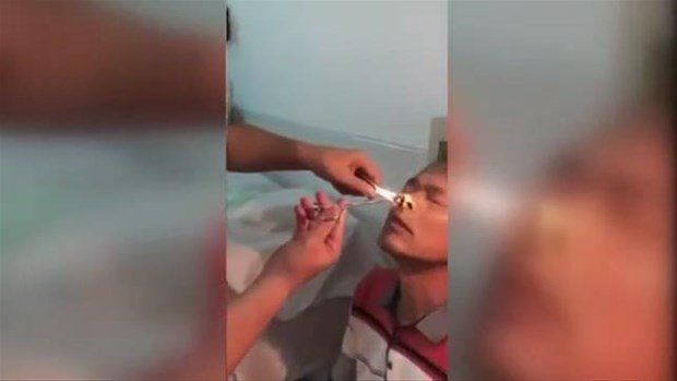 Yer: Zonguldak! 50 yıldır yüzündeydi... Ameliyatla burnundan çıkarılanlar şoke etti 8