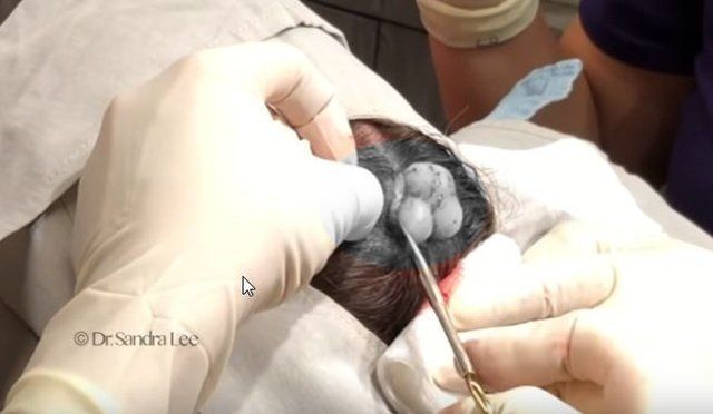 Yer: Zonguldak! 50 yıldır yüzündeydi... Ameliyatla burnundan çıkarılanlar şoke etti 80