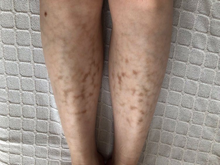 Laptop kullananlar risk altında! Hastalığın adı bile korkutuyor! Bu lekeler hastalığın ilk belirtisi 6