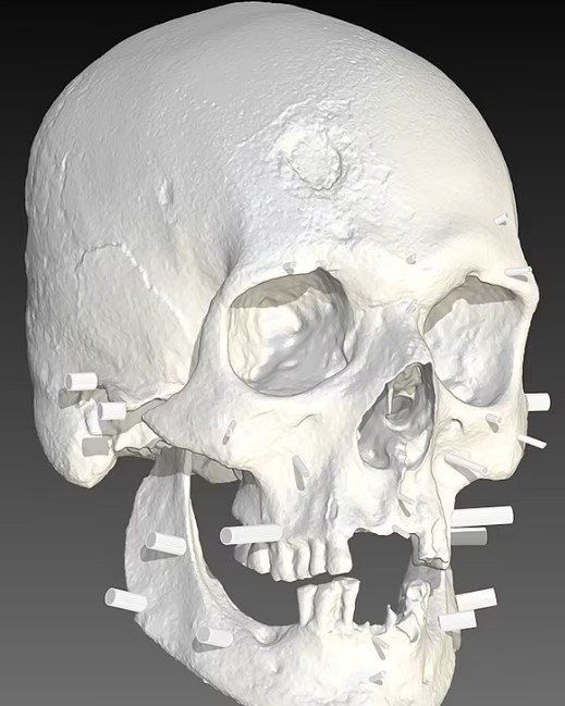 200 yıl önce yaşamış bir vampirin görüntüsü ortaya çıktı! Kemiklerindeki ayrıntı herkesi şaşırttı 3