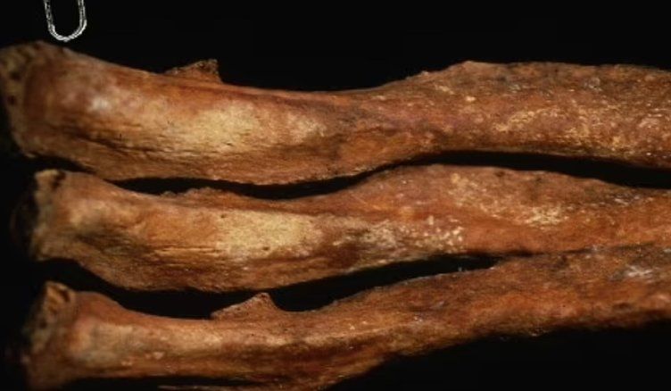 200 yıl önce yaşamış bir vampirin görüntüsü ortaya çıktı! Kemiklerindeki ayrıntı herkesi şaşırttı 4