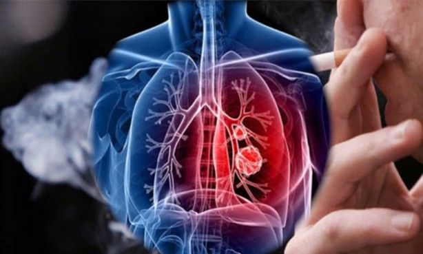 En ölümcül kanser türüne dikkat! O bulgular akciğer kanseri belirtisi olabilir! 13