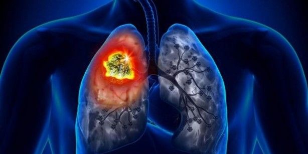 En ölümcül kanser türüne dikkat! O bulgular akciğer kanseri belirtisi olabilir! 11