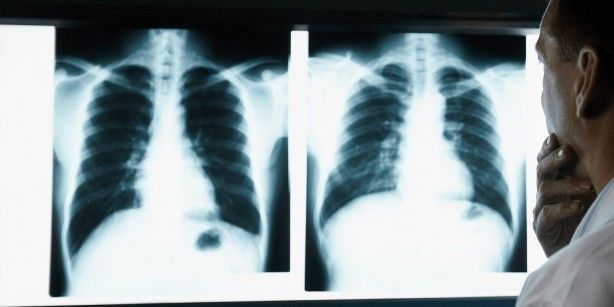 En ölümcül kanser türüne dikkat! O bulgular akciğer kanseri belirtisi olabilir! 5