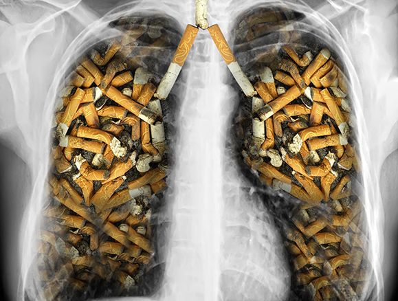 En ölümcül kanser türüne dikkat! O bulgular akciğer kanseri belirtisi olabilir! 18