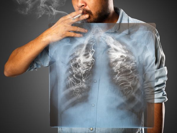 En ölümcül kanser türüne dikkat! O bulgular akciğer kanseri belirtisi olabilir! 7