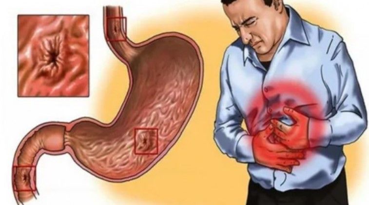 Ağız içinde çıkan yaralara dikkat! Kanser tehlikesiyle karşı karşıya olabilirsiniz 2