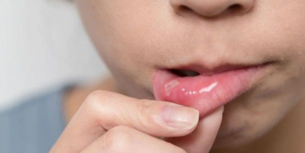Ağız içinde çıkan yaralara dikkat! Kanser tehlikesiyle karşı karşıya olabilirsiniz 3