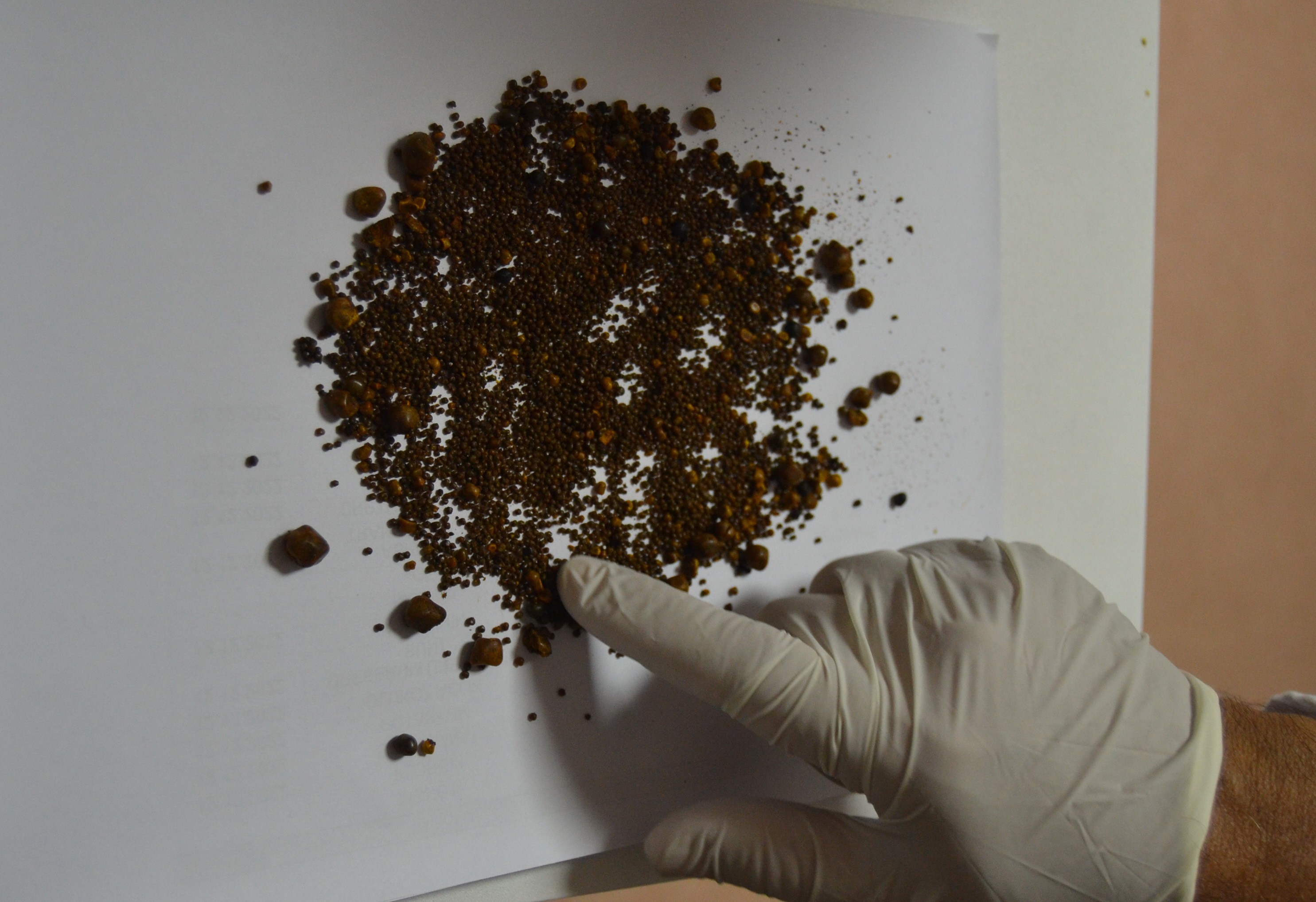 Şiddetli karın ağrısı şikayetiyle gitti! 4 bin 536 tane çıkarıldı 6