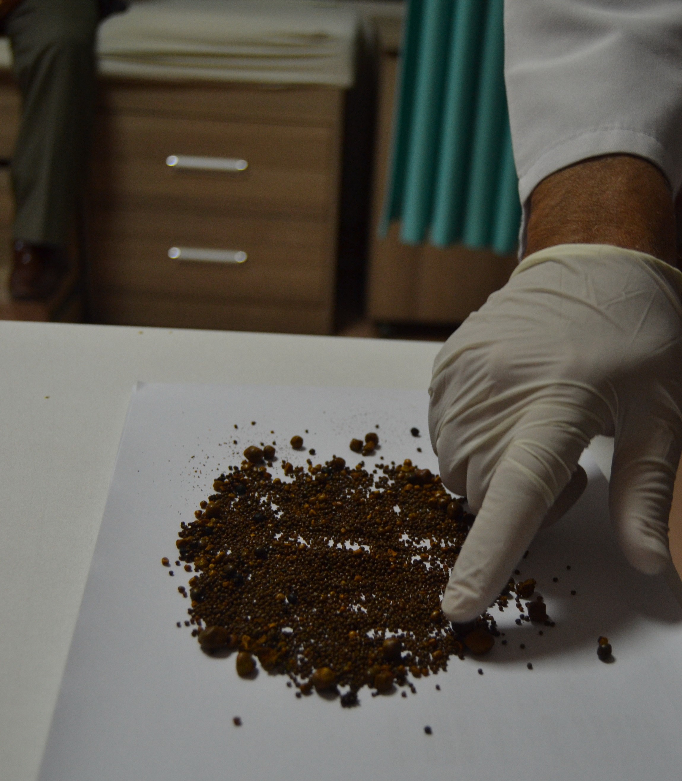 Şiddetli karın ağrısı şikayetiyle gitti! 4 bin 536 tane çıkarıldı 4