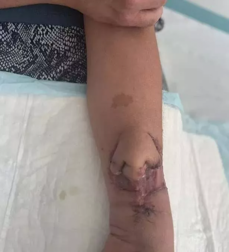 Tıp dünyası şaşkına döndü! Kaybettiği burnu kolunda yeniden çıktı 3