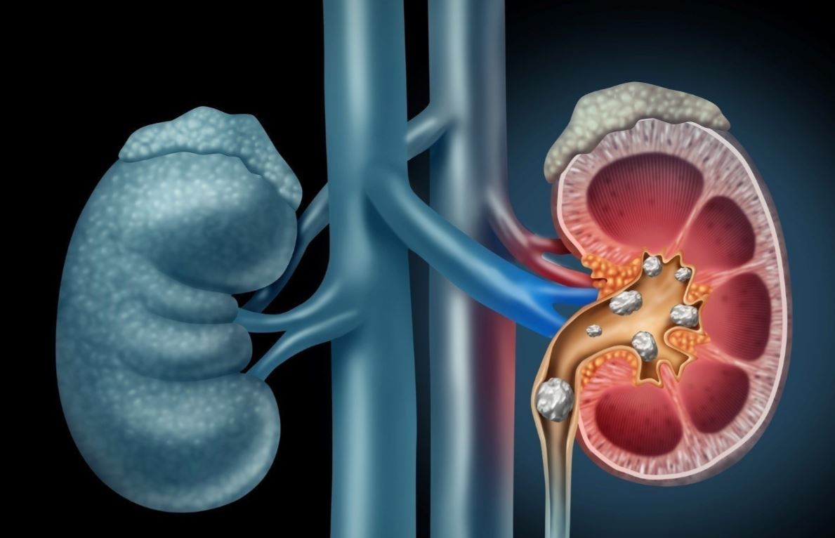 Tükettiğiniz anda böbrek taşına neden oluyor! Bu zararını bilmeden tüketiyoruz 14