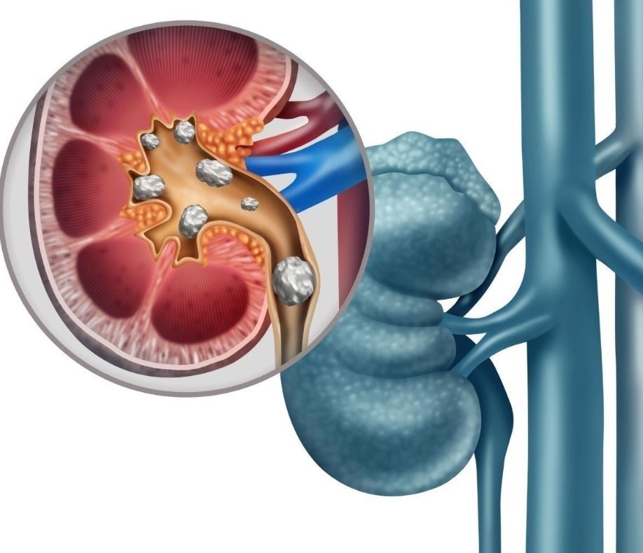 Tükettiğiniz anda böbrek taşına neden oluyor! Bu zararını bilmeden tüketiyoruz 15