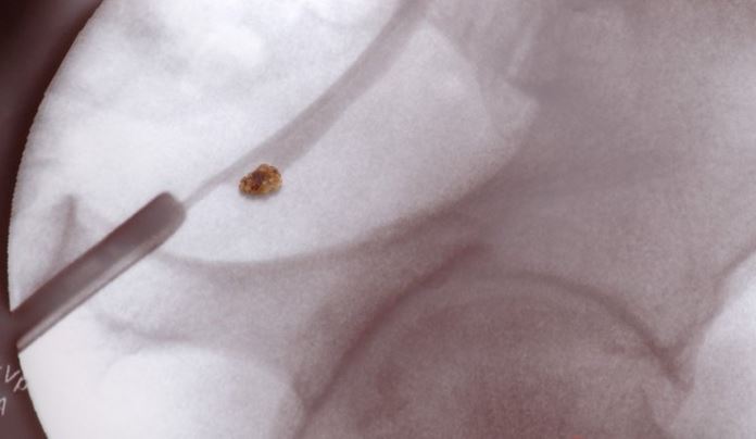 Tükettiğiniz anda böbrek taşına neden oluyor! Bu zararını bilmeden tüketiyoruz 2