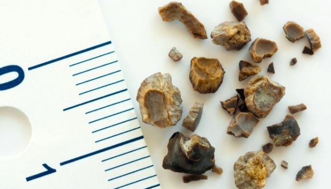 Tükettiğiniz anda böbrek taşına neden oluyor! Bu zararını bilmeden tüketiyoruz 5