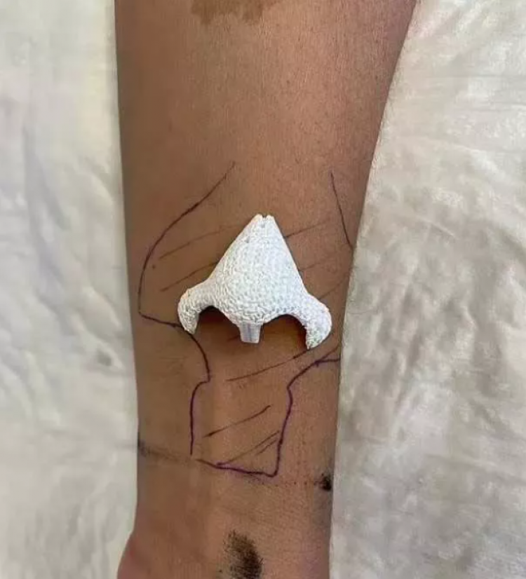 Tıp dünyası şaşkına döndü! Kaybettiği burnu kolunda yeniden çıktı 2