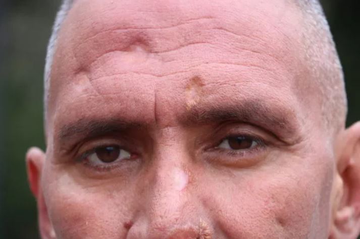 Çalışmak için Antalya'ya gitti hayatı karardı! Her şey bir ısırıkla oldu 6