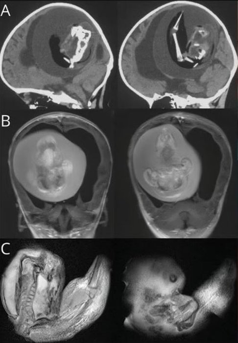 Çin'de akılalmaz olay! İkiz kardeşinin kafatasından çıkarıldı 3