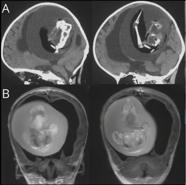 Çin'de akılalmaz olay! İkiz kardeşinin kafatasından çıkarıldı 4