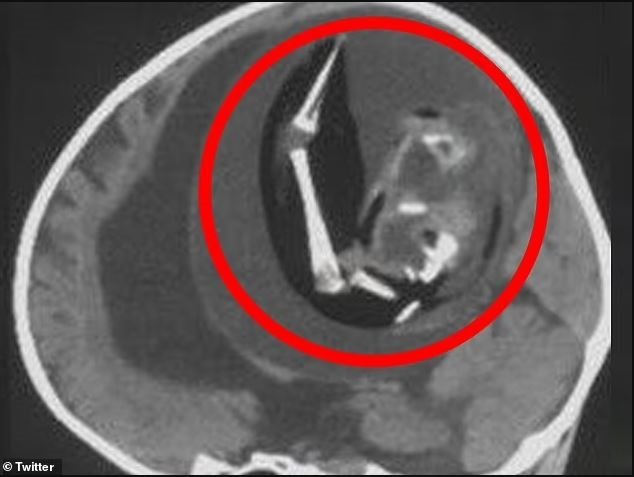 Çin'de akılalmaz olay! İkiz kardeşinin kafatasından çıkarıldı 5