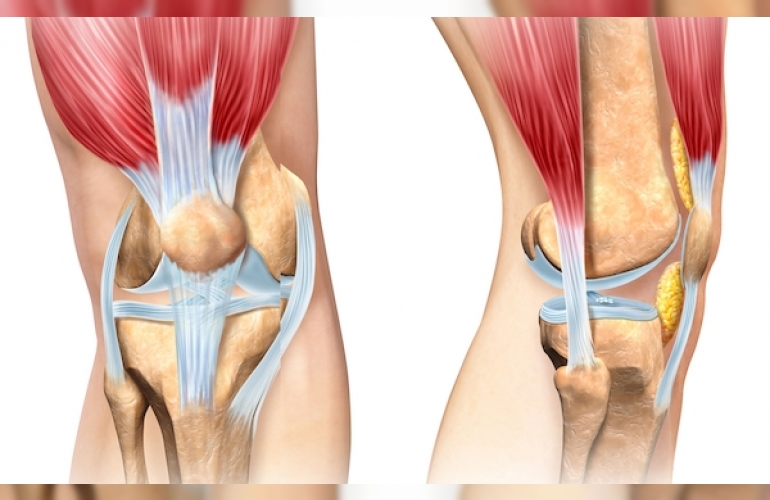 Göbek yağları diz ağrılarına merhem oldu 3